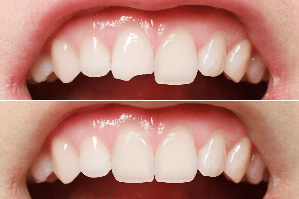 Tooth-Colored Fillings